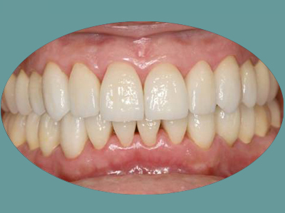 An image of a close-up view of a person s teeth with a focus on the front teeth, showcasing a bright and clean smile.