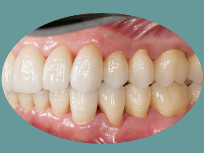 The image shows a close-up of a person s teeth with a focus on the front row, revealing a set of yellowed teeth.