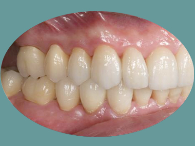 An image of a close-up view of a human mouth with teeth, featuring an upper denture with visible pink gums.
