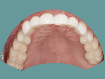 An image of a close-up view of an open mouth with teeth and gums, showcasing dental health.
