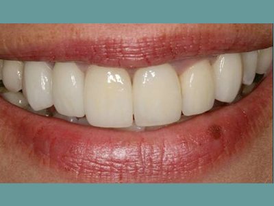 Smiling woman with teeth whitening treatment, showcasing the results of cosmetic dental care.