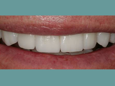 The image shows a close-up of a person s teeth with a focus on the bright white smile and clean teeth, set against a blue background.