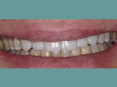 The image shows a person with a wide smile, displaying yellowish teeth and a visible dental bridge or implant.