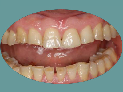 The image depicts a close-up of an open mouth with visible teeth and gums, likely for dental or medical purposes.