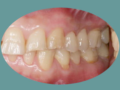 An image of a close-up view of a person s teeth, showcasing a smile with visible dental work.
