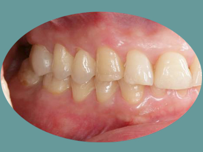 The image displays a close-up of a dental implant with visible screws and a pinkish gum line.