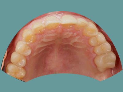 The image shows a close-up of an open human mouth with visible teeth and gums, revealing the interior of the oral cavity.