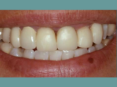 The image shows a person smiling with white teeth, and the focus is on their mouth.
