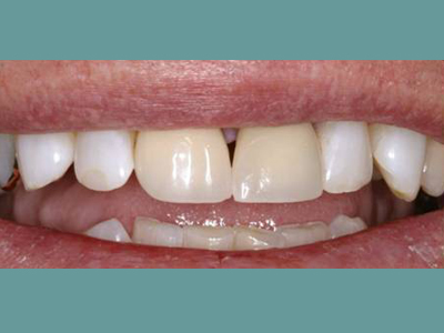 Smiling mouth with white teeth and a person s chin visible, against a blue background.