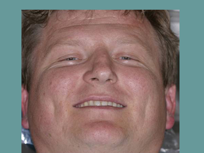 The image is a photograph of a man with a broad smile, showcasing his teeth and facial features. He appears to be middle-aged, with fair skin and a light beard. The background is indistinct but seems to be an indoor setting, possibly a medical or dental office due to the presence of what looks like a blue fabric or drape behind him.