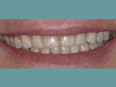 The image shows a close-up of a person's smile, revealing a set of teeth with some yellowing and staining.