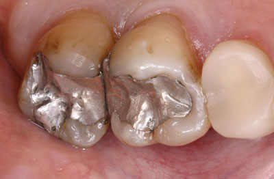 The image shows a close-up view of a person's mouth with teeth, some of which have silver fillings and one tooth has a broken filling.