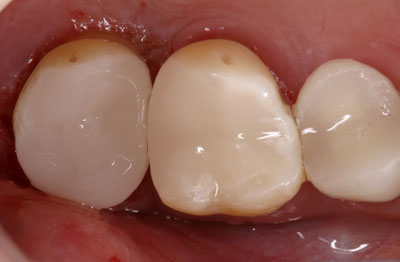 Oral cavity with a partially eaten lower front tooth, showing signs of decay and wear.