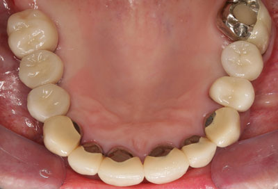 The image shows a close-up view of a person's teeth, with the upper front teeth prominently visible and appearing to be chipped or broken.