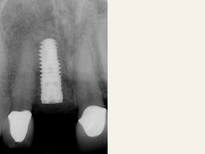 The image shows a close-up of a dental implant with a screw visible, placed against a contrasting background that highlights the object.