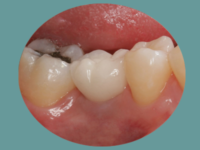 The image shows a close-up of an oral cavity with teeth, gums, and part of the tongue visible.