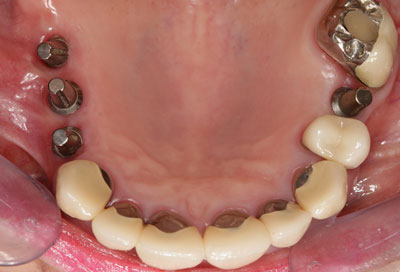 The image shows a person's mouth with visible dental implants and braces, featuring a bright smile.