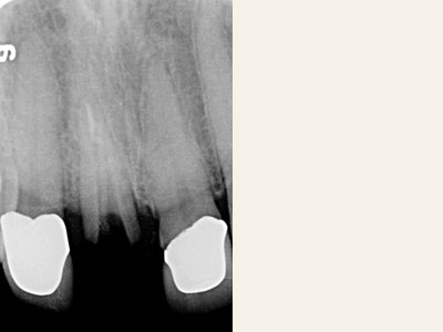 The image features a close-up view of a dental X-ray, specifically focusing on the upper and lower teeth with fillings.