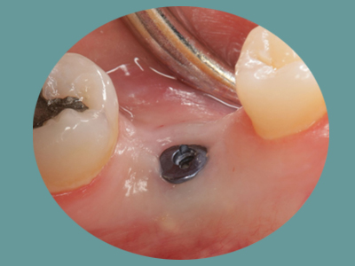 The image shows a close-up of a dental implant being placed in a person's mouth, with the focus on the surgical screw and surrounding oral tissue.