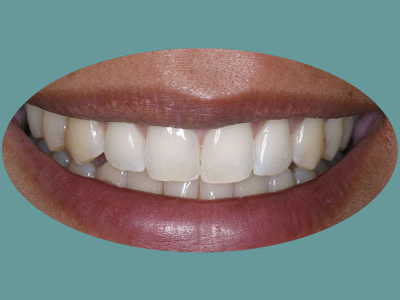 The image displays a close-up of a person's smiling mouth with straight white teeth, and the text 'Teeth Whitening' is visible at the bottom.