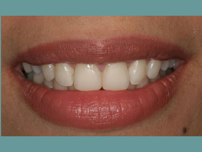 The image features a close-up of a person's face with a focus on their teeth, which are white and well-maintained. The individual is smiling, revealing the teeth, and has a light skin tone.