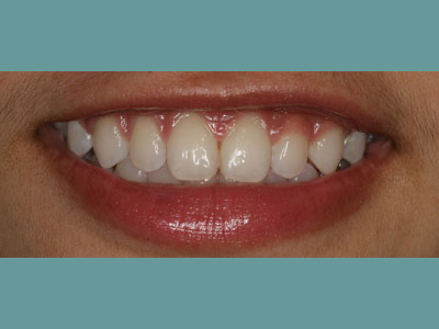 The image shows a close-up of a person's face, focusing on their teeth and lips.