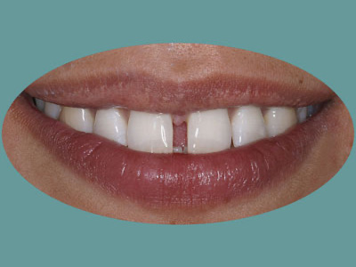 The image shows a close-up of a person's mouth with teeth, featuring a smile and the upper lip.