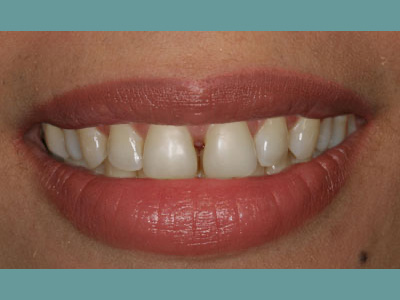 The image displays a close-up of a person's smiling face with teeth, showing a clear and healthy oral hygiene.