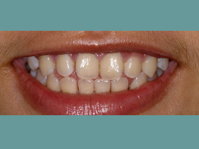 The image shows a close-up of a person smiling, revealing straight white teeth and pink gums.