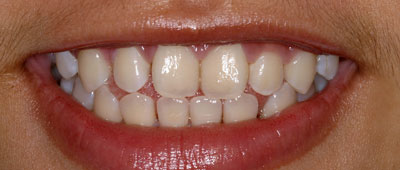 Smiling person with a focus on dental hygiene, showcasing bright teeth and healthy gums.