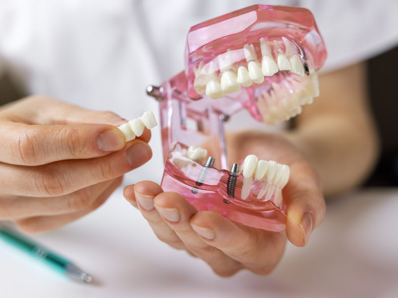 Hand holding a pink toothbrush in front of a dental model with a clear plastic mouthpiece.