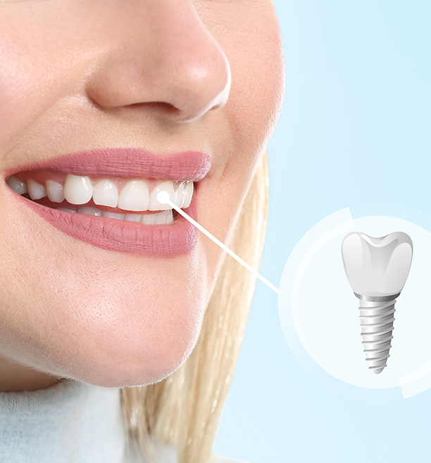 An image of a smiling woman with an implanted dental implant, showcasing the product in a real-life context.