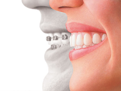 An advertisement for dental implants featuring a smiling woman and a man s face with a missing tooth.