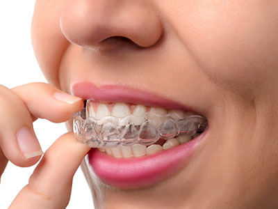The image shows a person with clear, straight teeth wearing a transparent aligner, which is typically used in orthodontic treatment.