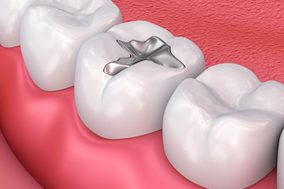 The image displays a close-up view of a dental implant inserted into a tooth with a pink gum background and no visible text.