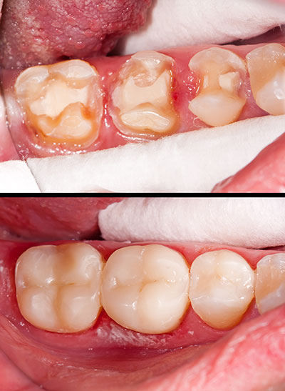 The image shows a person s mouth with teeth that appear to be in poor condition, possibly due to decay or gum disease.