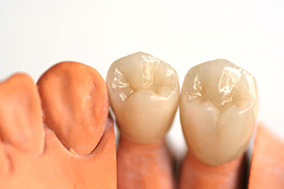 The image shows a set of artificial teeth, placed side by side, with one tooth having a visible crown and the other showing an intact root structure.