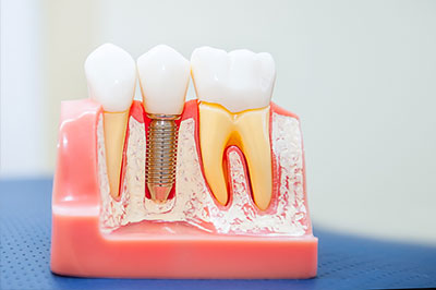 Tooth model with metal screws, showcasing dental implantation process.