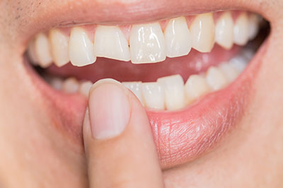 The image shows a close-up of a person s teeth with a focus on the lower front tooth, which appears to be chipped or broken. The individual is holding their finger near the damaged tooth, and there is a slight smile revealing the imperfection.