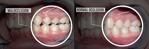The image shows a side-by-side comparison of a tooth with malocclusion and the same tooth after orthodontic treatment, highlighting the improvement in alignment.