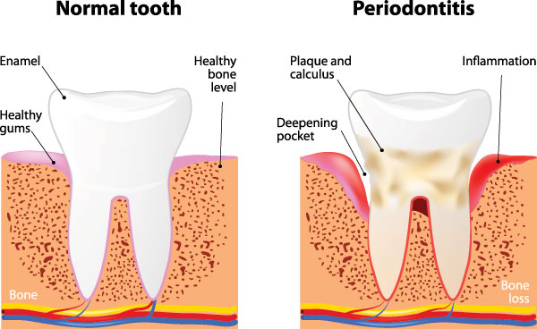 The image is a medical illustration that depicts the stages of tooth decay, from normal to severe, with labels indicating the progression and the presence of periodontitis.