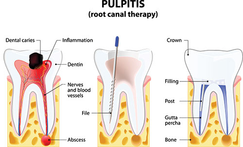 The image shows a diagrammatic illustration of the pulpitis process in teeth, with labels indicating dental caries, inflammation, and a toothbrush. It also includes annotations for a crown, dental caries, nerves, and filling materials.