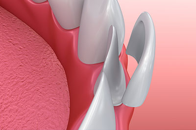 The image shows a close-up view of a dental implant with a metal screw and abutment, set against a pink background that resembles gum tissue.